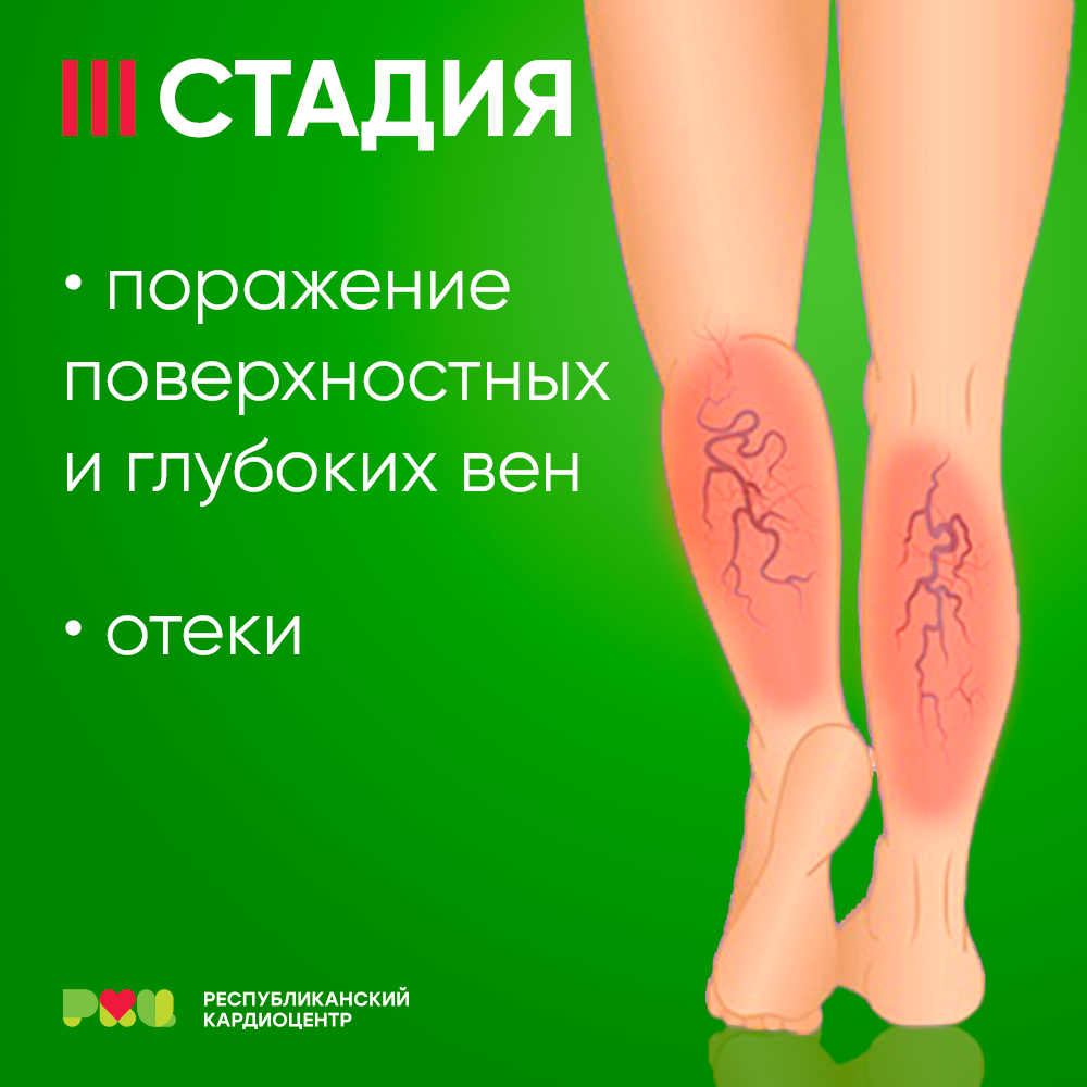 Тяжесть в ногах вены. Реклама варикоза вен на ногах.